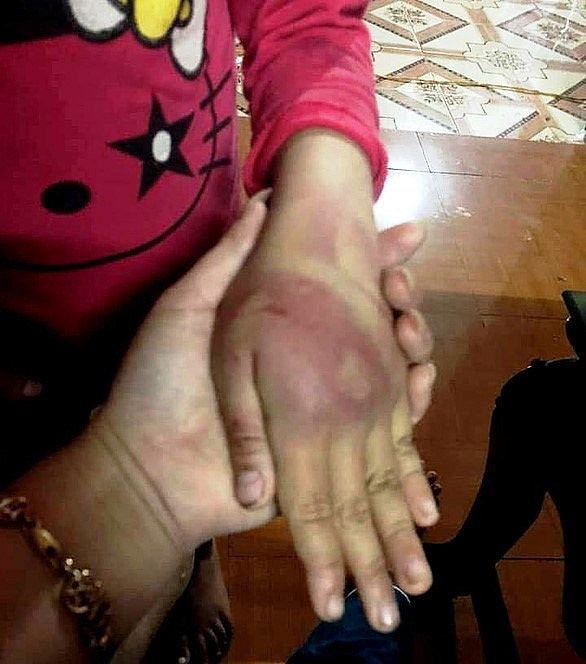 Bố bị phạt 2,5 triệu đồng vì đánh bầm dập con gái 8 tuổi ở Triệu Sơn Thanh Hóa